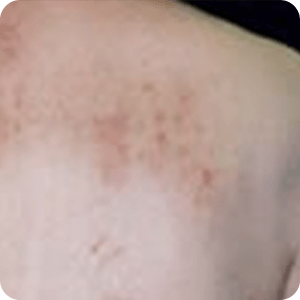 皮膚掻痒症の症例画像