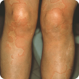 アトピー性皮膚炎：左右対称の皮膚炎・かぶれ