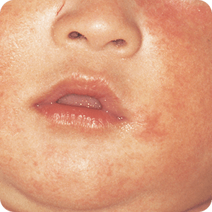 アトピー性皮膚炎：乳児期では頬にジュクジュクした発疹