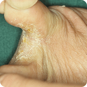 白癬 水虫 たむしなど の症状 治療法 症例画像 田辺三菱製薬 ヒフノコトサイト