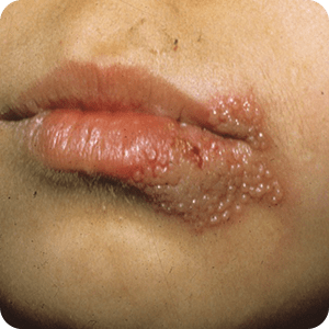口唇ヘルペスの症状 治療法 症例画像 田辺三菱製薬 ヒフノコトサイト