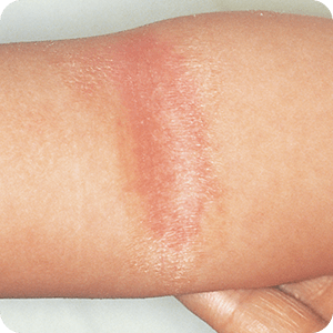 アトピー性皮膚炎：ひじやひざの内側にできる皮膚炎・かぶれ