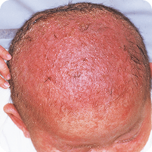 脂漏性皮膚炎の症状 治療法 症例画像 田辺三菱製薬 ヒフノコトサイト