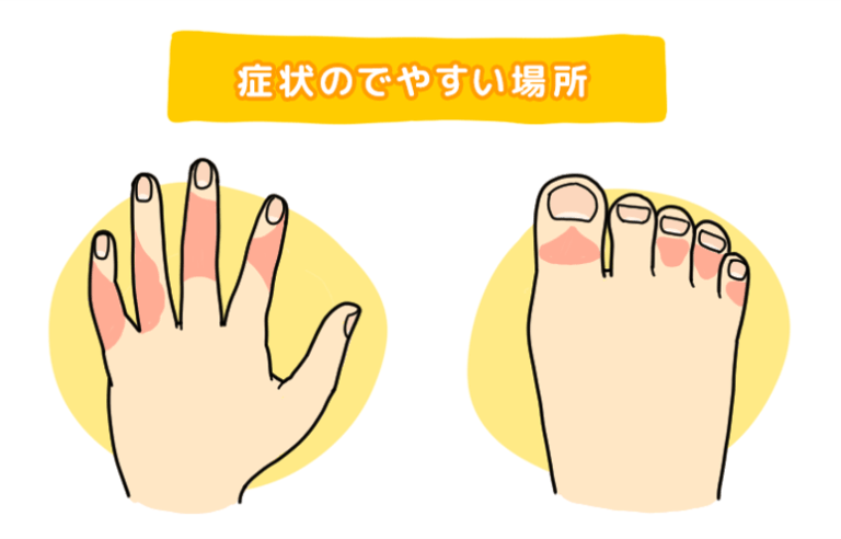 症状のでやすい場所として、手や足の指、特に関節周りを示した図