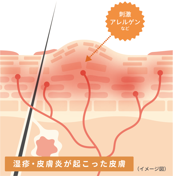 湿疹・皮膚炎が起こった皮膚（イメージ図）